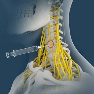 Diplomado Avanzado en Bloqueos Ecoguiados para Manejo del Dolor y Anestesia Regional: Técnicas de Precisión y Seguridad